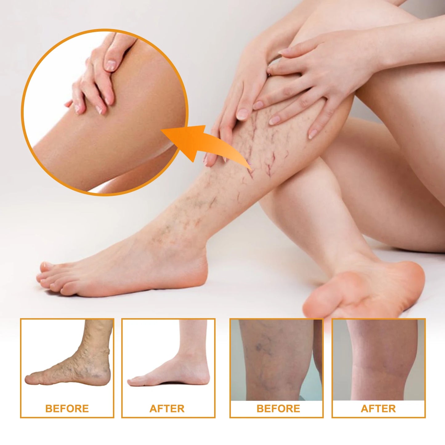 Eelhoe Vitamin K Cream for Varicose Veins and Leg Swelling