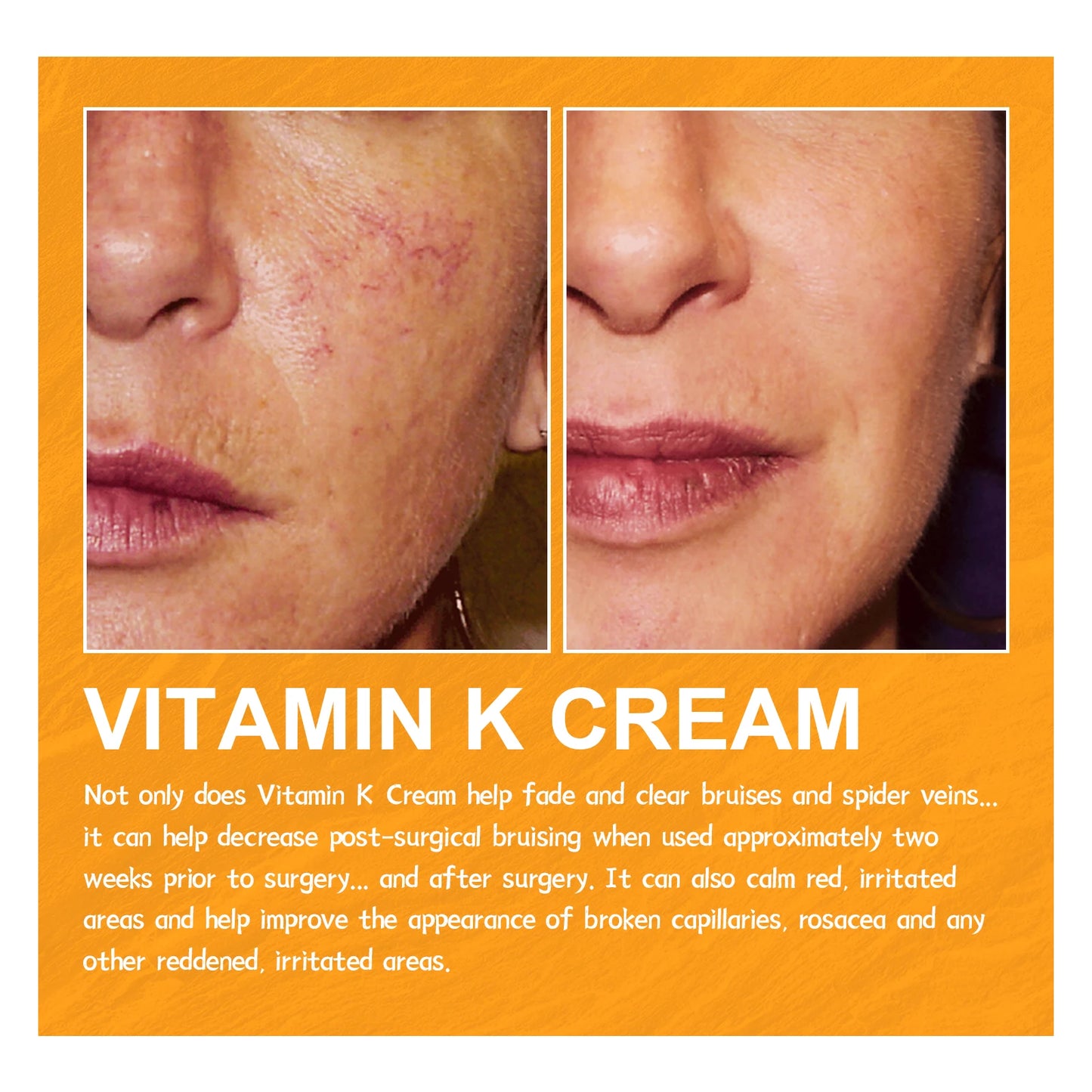 Eelhoe Vitamin K Cream for Varicose Veins and Leg Swelling