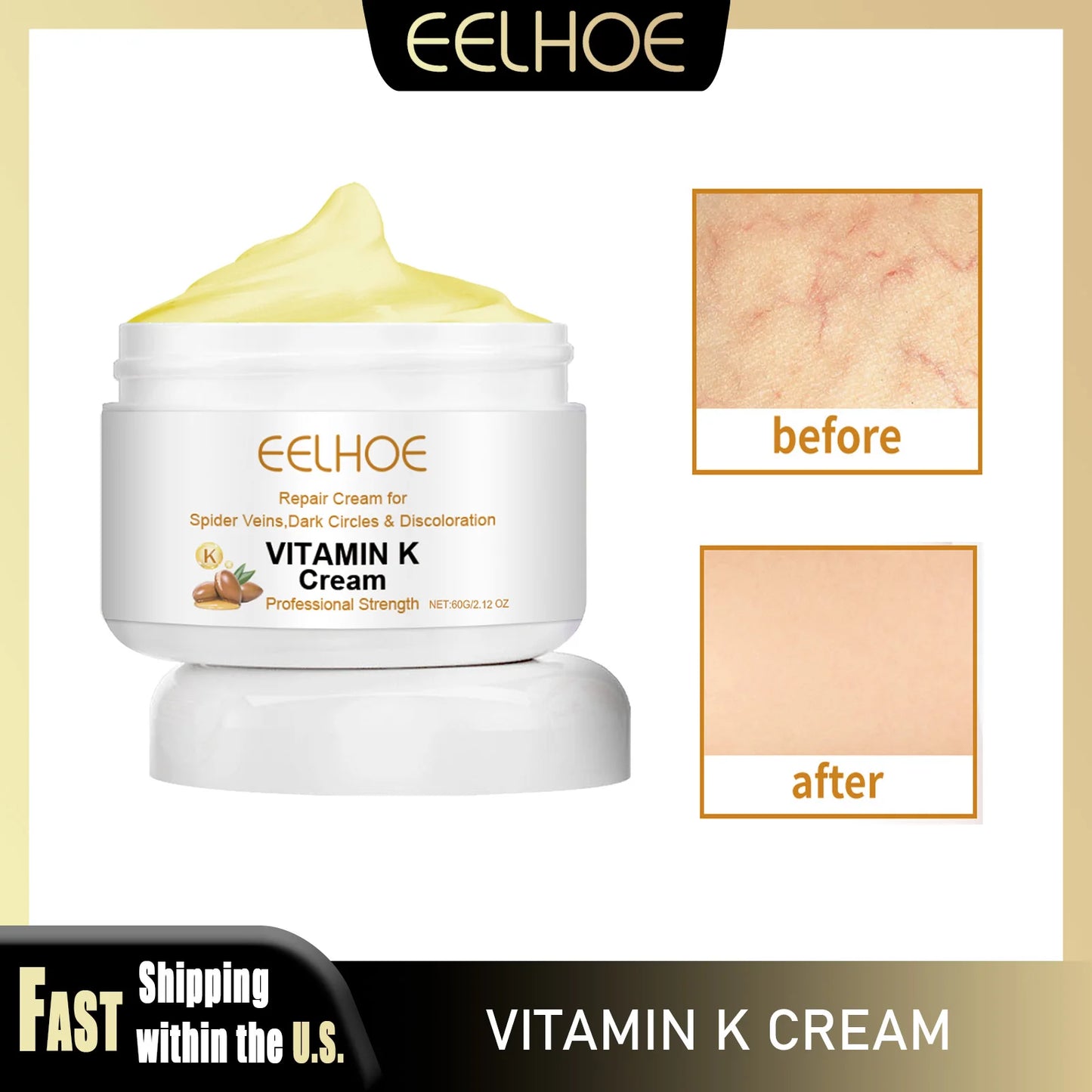 Eelhoe Vitamin K Cream for Varicose Veins and Leg Swelling